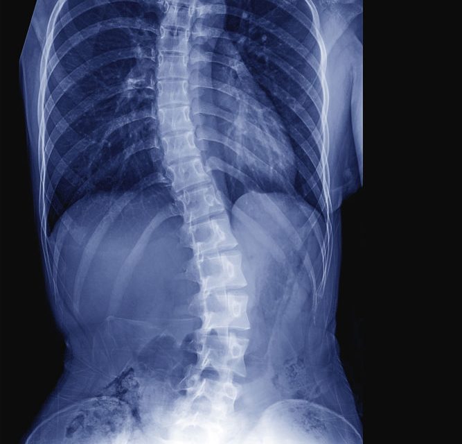 scoliosis